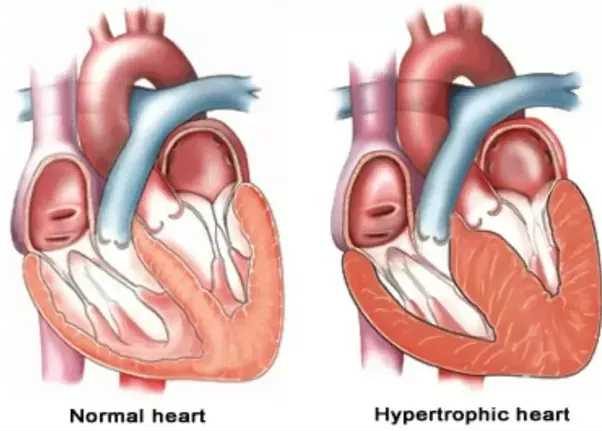 Enlargement Of Heart Muscles
